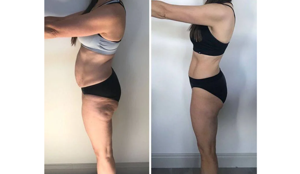 BODY BLISS аппаратный массаж